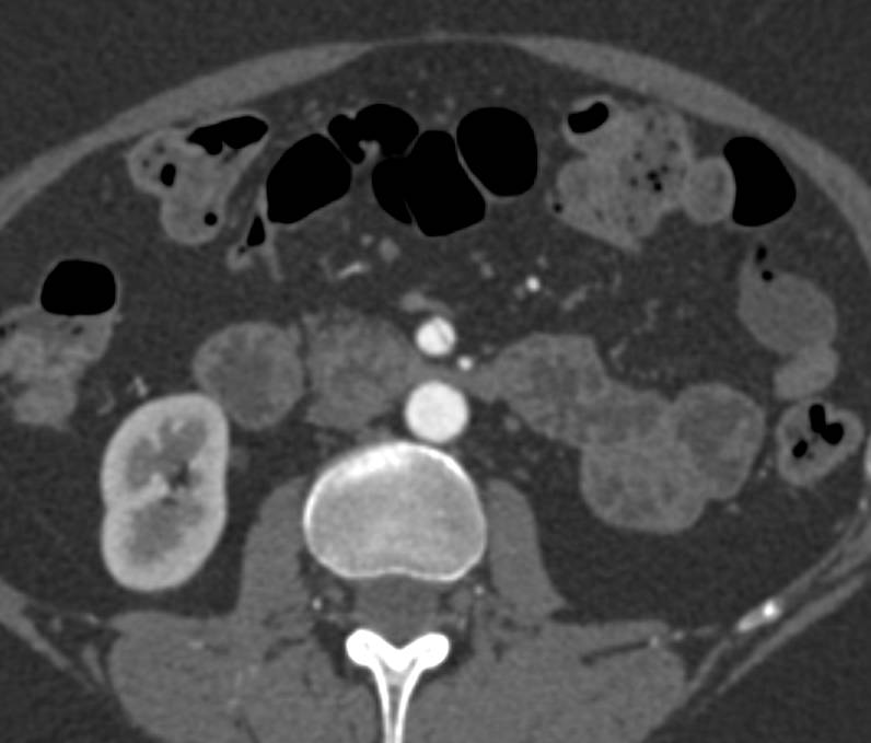 Focal Aneurysm of the Superior Mesenteric Artery (SMA) with Dissection - CTisus CT Scan