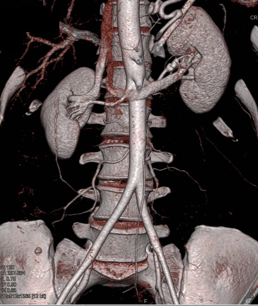 Focal Aneurysm of the SMA with Dissection - Vascular Case Studies ...