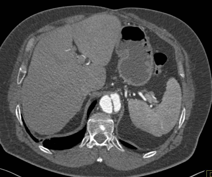 Aortic Dissection with Extension into the Superior Mesenteric Artery (SMA) with Stent in Place - CTisus CT Scan