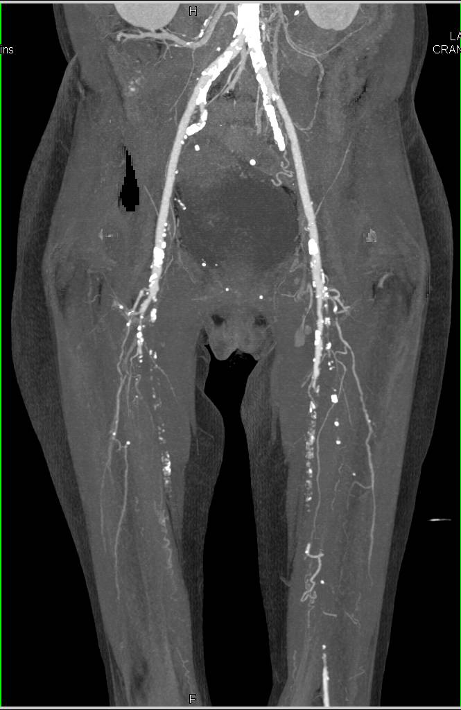 CTA Runoff with Extensive Peripheral Vascular Disease (PVD) - CTisus CT Scan