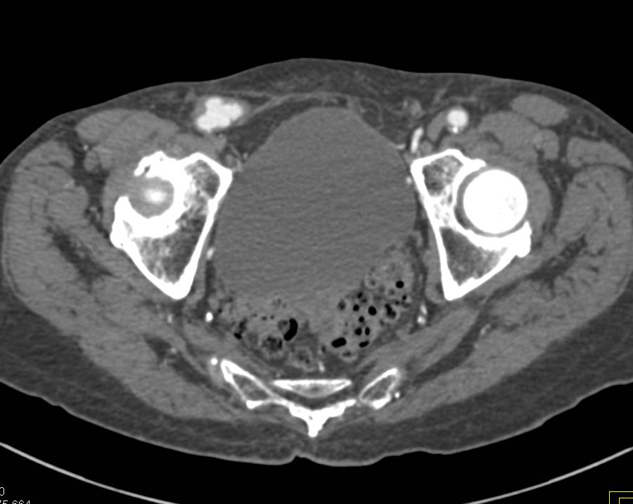 Extensive Aortic Disease in Chest and Abdomen with a Nice Example of a Fem-Fem Bypass Graft - CTisus CT Scan