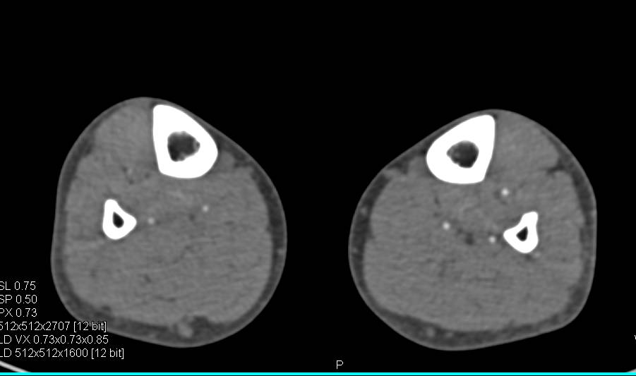 CTA Runoff with Peripheral Vascular Disease (PVD) Using Bone Editing - CTisus CT Scan