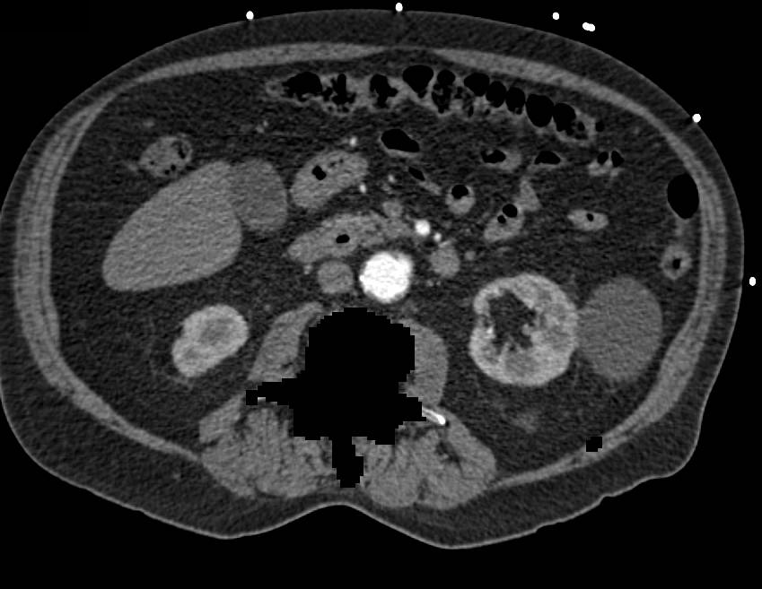 CTA Runoff with Extensive Peripheral Vascular Disease (PVD) and Occluded Stent on the Left. Images Done with Bone Removal - CTisus CT Scan