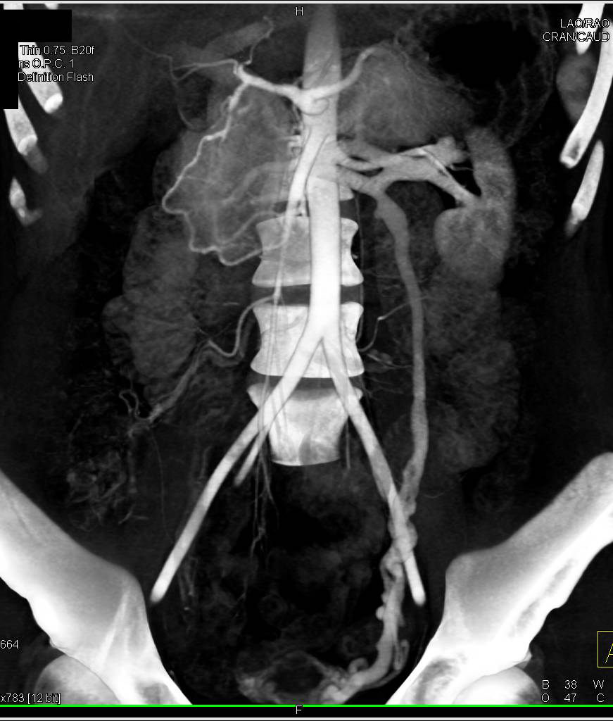 Beautiful 3D Demonstration of a Prominent Left Gonadal Vein - CTisus CT Scan