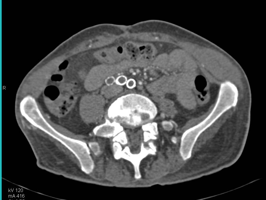 CTA Runoff with Graft on Right Occluded with Left AKA (above-the-knee amputation) - CTisus CT Scan