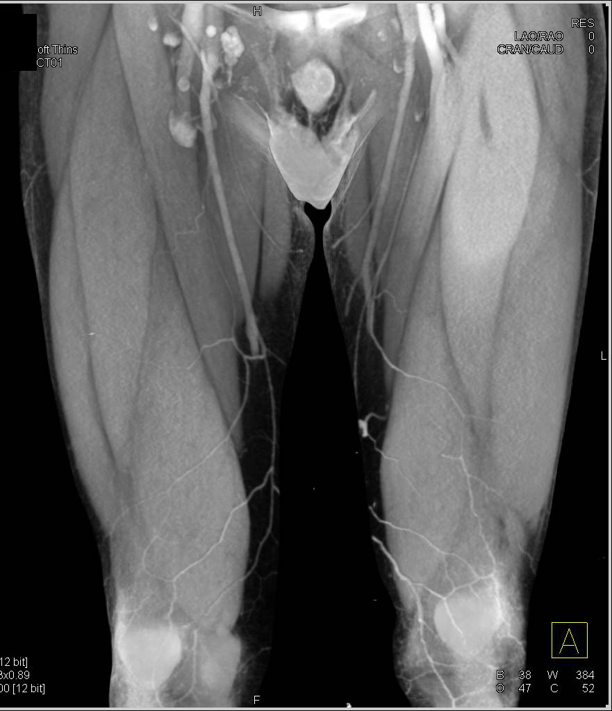 CTA Runoff with Occlusion of the Right Superficial Femoral Artery (SFA) with Collaterals - CTisus CT Scan