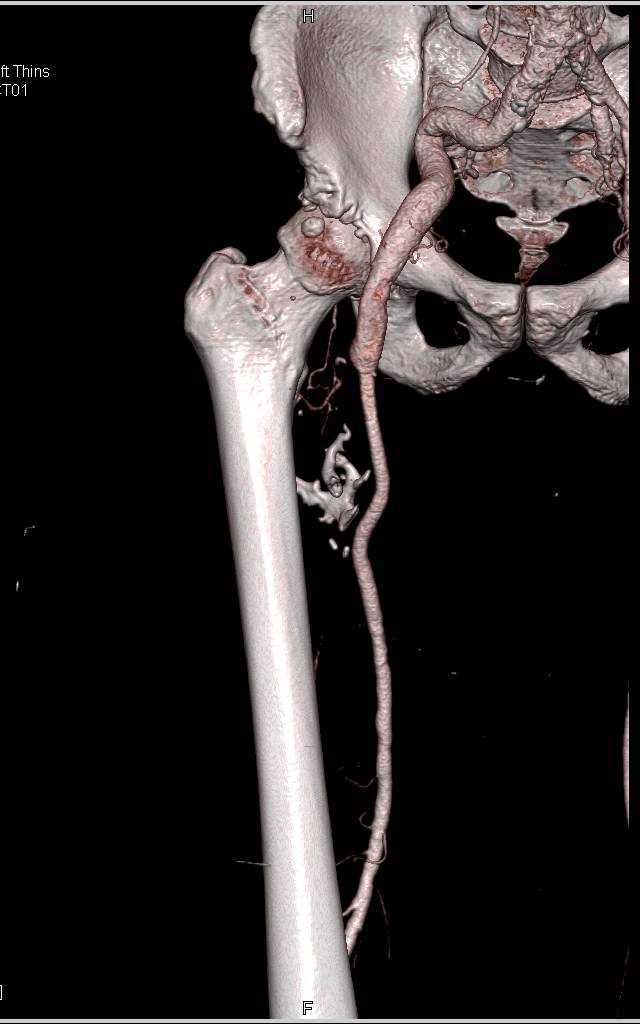 CTA runoff with Vessel Patency Following Repair - CTisus CT Scan