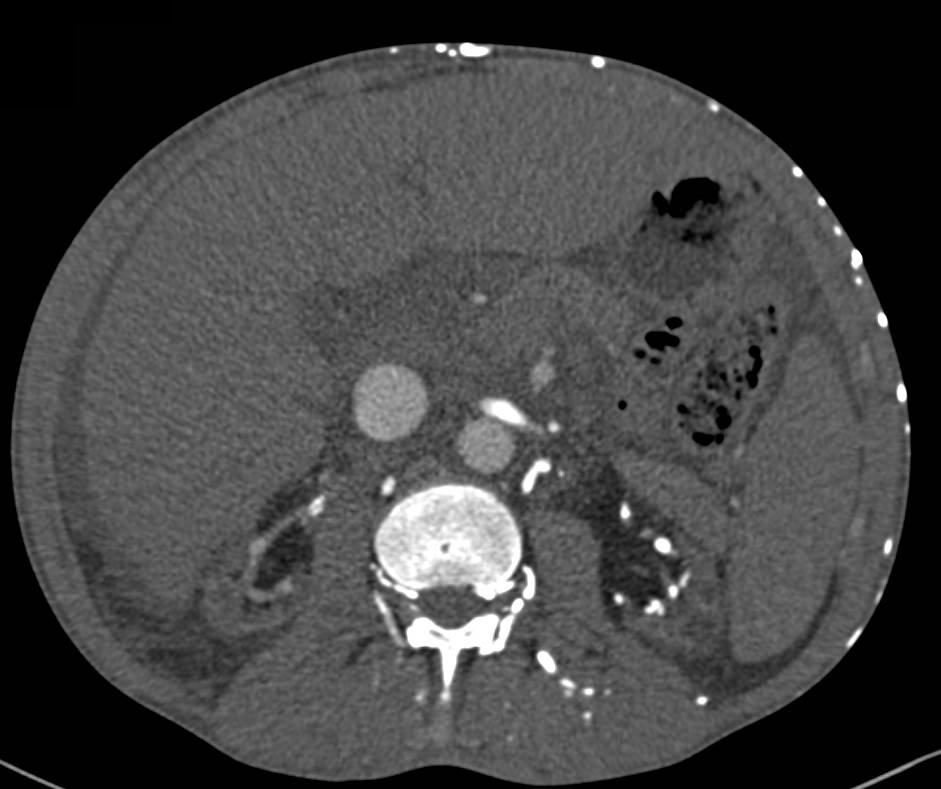 Superior Vena Cava (SVC) Occlusion with Extensive Collateral Pathways in a Patient with End Stage Renal Disease (ESRD). Look at Abdominal Wall Collaterals. - CTisus CT Scan