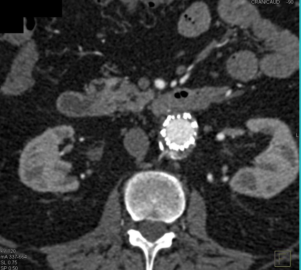 Endovascular Stent with Endoleak Seen on both Early and Late Phase Images - CTisus CT Scan