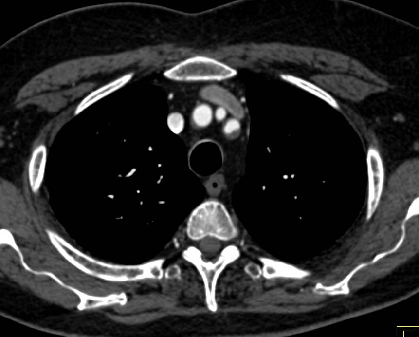 Abdominal Aortic Aneurysm (AAA) with Multiple Ulcerating Plaques in the Thoracic Aorta - CTisus CT Scan