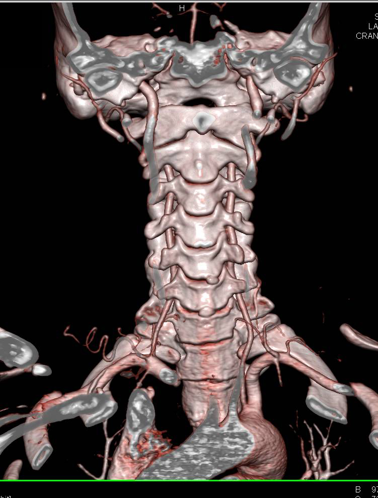 CTA of the Entire Vascular Map Using a Flash Acquisition - CTisus CT Scan