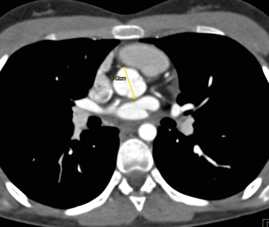 High Pitch Acquisition Allows Aortic Root Visualization and Vascular System fro Circle of Willis to Carotids to Iliacs - CTisus CT Scan