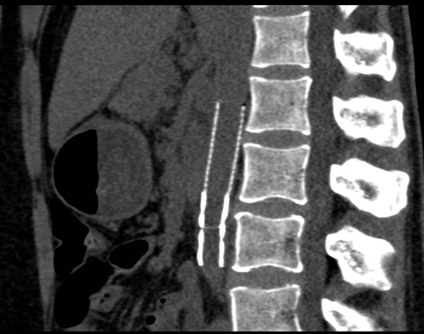 CTA of Stent Placed in the Abdominal Aorta to Repair Aortic Trauma - CTisus CT Scan