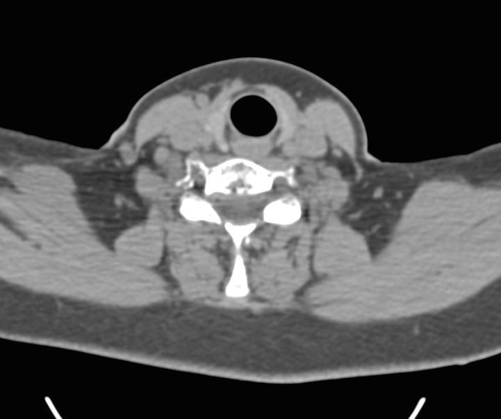 CTA of the Aortic Arch with 3D Mapping - CTisus CT Scan