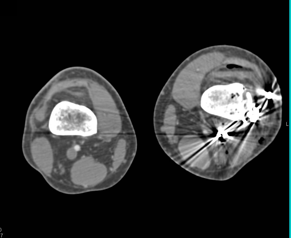 Gun Shot Wound to the Knee with Femur Fracture but no Vascular Injury as seen on CTA - CTisus CT Scan