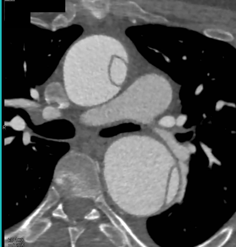 Type A Dissection with Aortic Root Repair - CTisus CT Scan