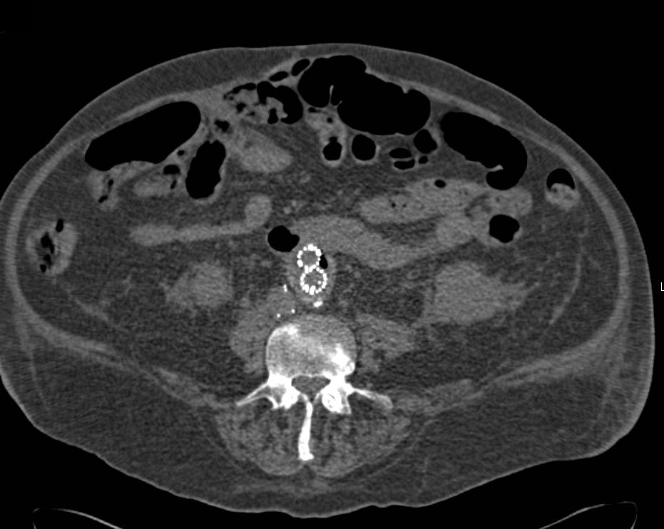 Fistulae Between Aorta and Small Bowel at Classic 3rd Portion of Duodenum - CTisus CT Scan