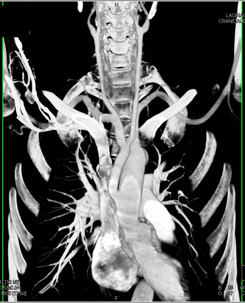 Ascending Aortic Aneurysm Repair with Innominate Graft Shown in 3D - CTisus CT Scan