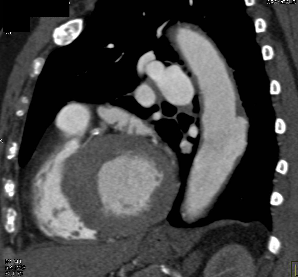 Focal Dissection in the Descending Aorta - CTisus CT Scan