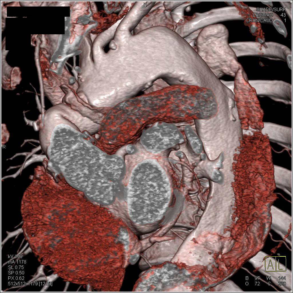 Type A Dissection Extends into Abdominal Aorta. Repair in Root Defined - CTisus CT Scan