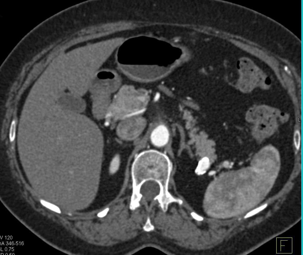 Multiple Mesenteric Artery Aneurysms Including Splenic Artery and Branch off the SMA - CTisus CT Scan