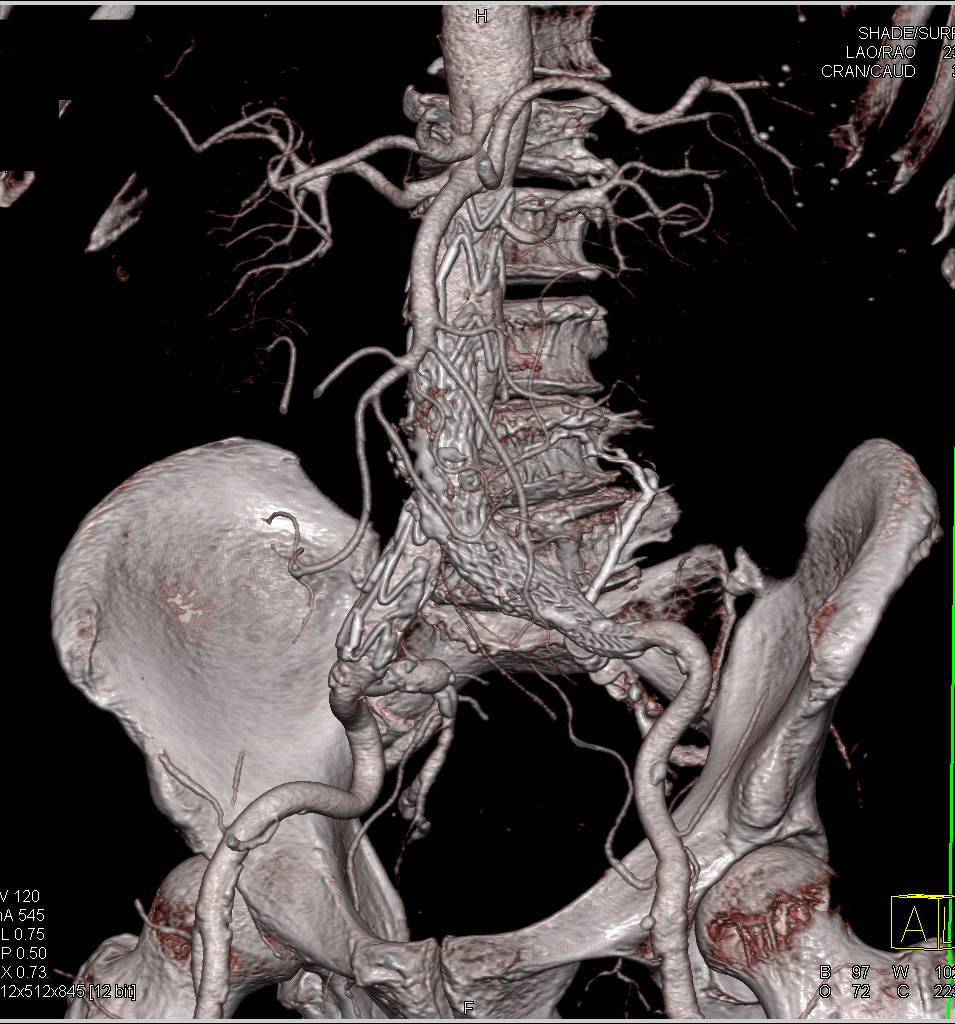 Endovascular Stent with Endoleak Seen on both Early and Late Phase Images - CTisus CT Scan