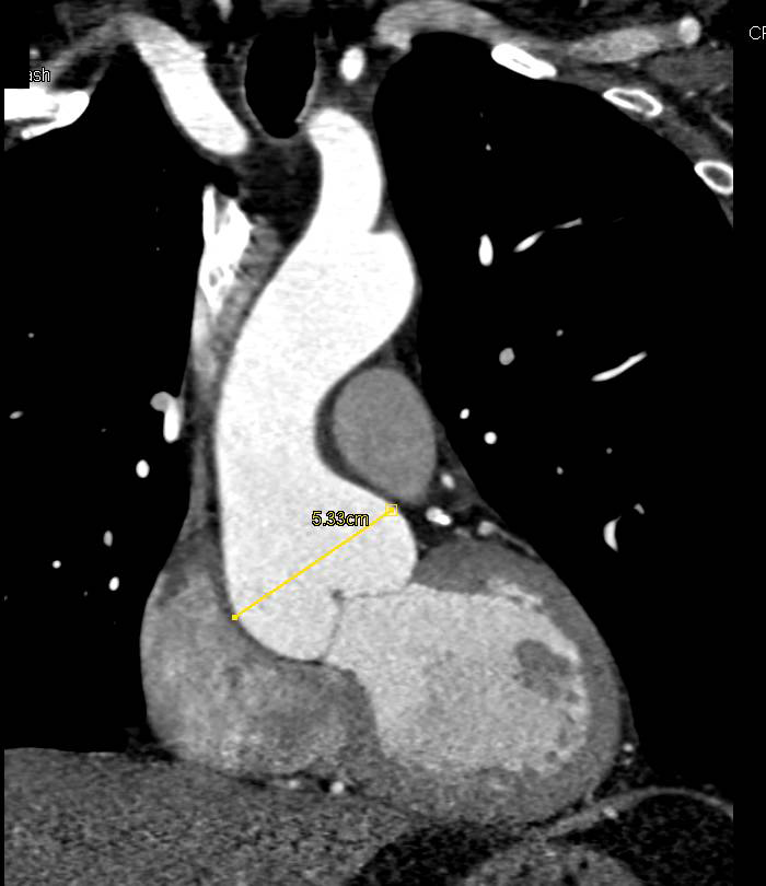 Dilated Root Including Sinus of Valsalva in Patient with Marfan's Syndrome - CTisus CT Scan