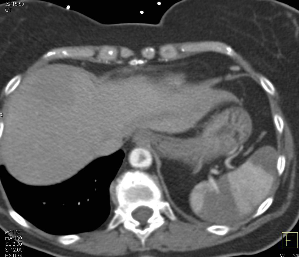 Ulcerating Plaque in Descending Thoracic Aorta, Thrombus in Left Atrial Appendage and Splenic Infarcts - CTisus CT Scan