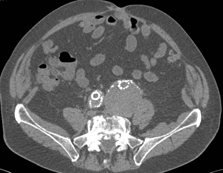 Left Common Iliac Artery Aneurysm Treated with an Endovascular Stent - CTisus CT Scan