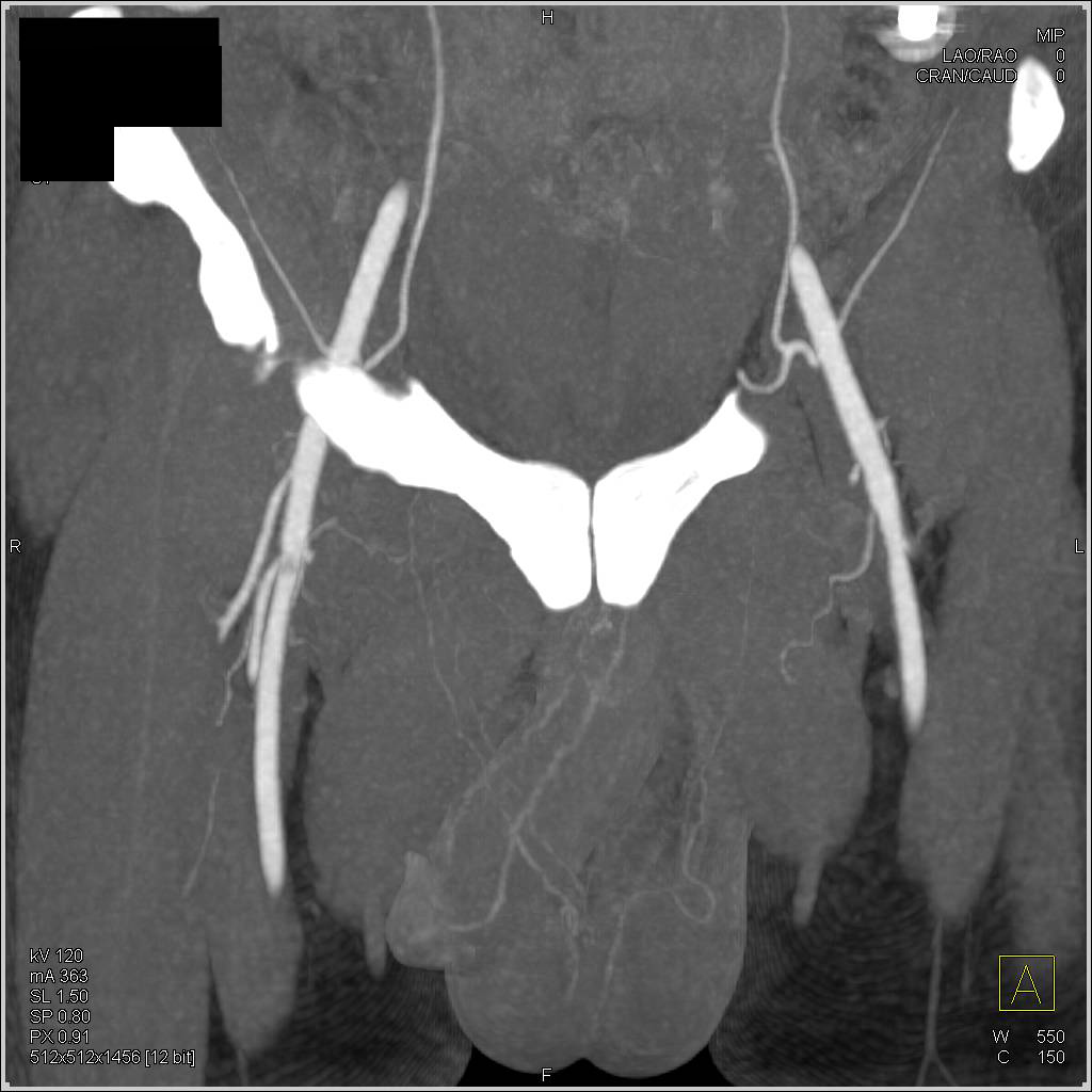 CTA Pelvis without Occlusion - CTisus CT Scan