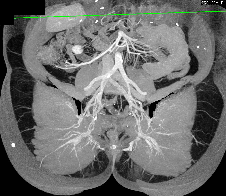 Vascular Mapping for Gluteal Perforators - CTisus CT Scan