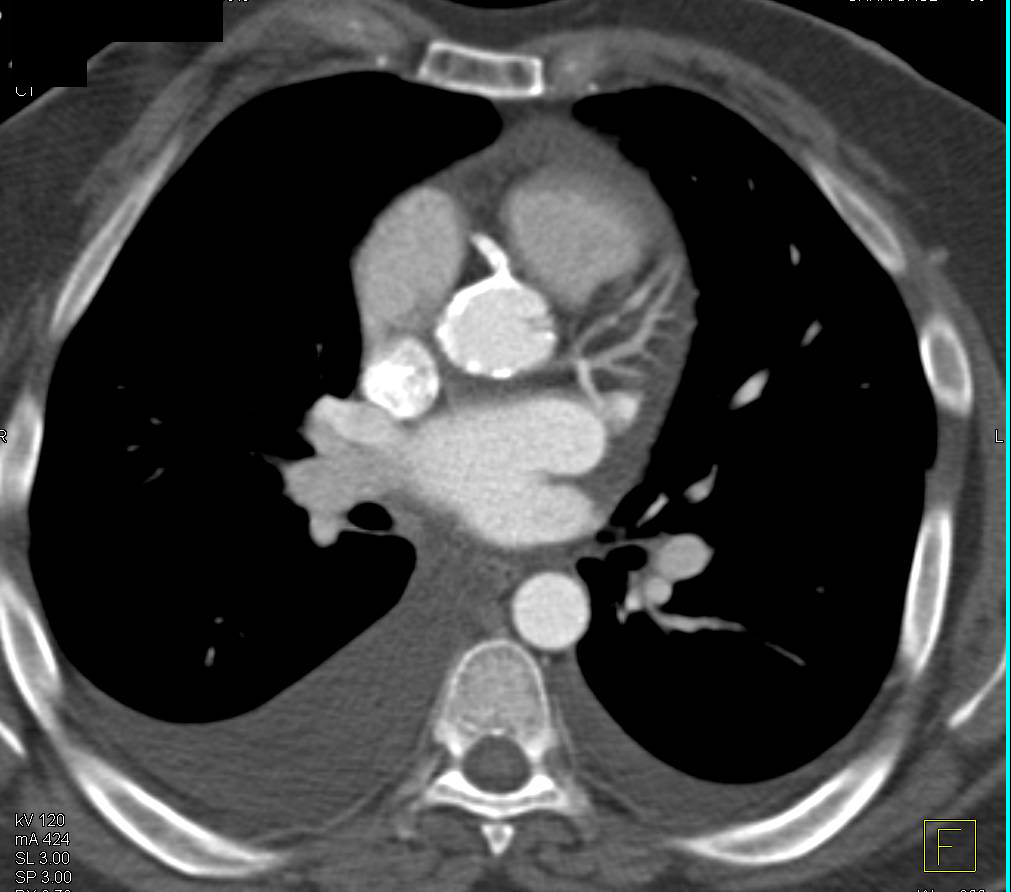 Aortic Root Calcification - CTisus CT Scan