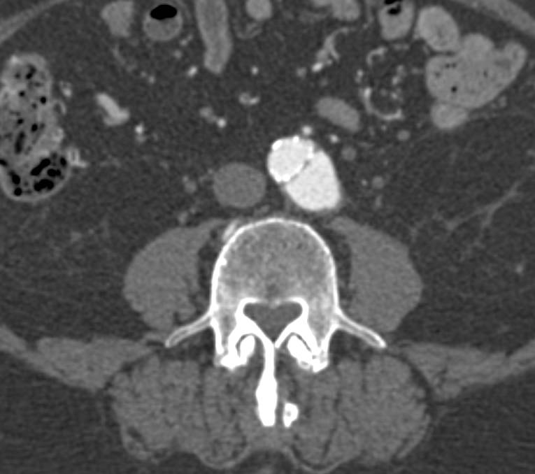 Focal Aortic Dissection - CTisus CT Scan