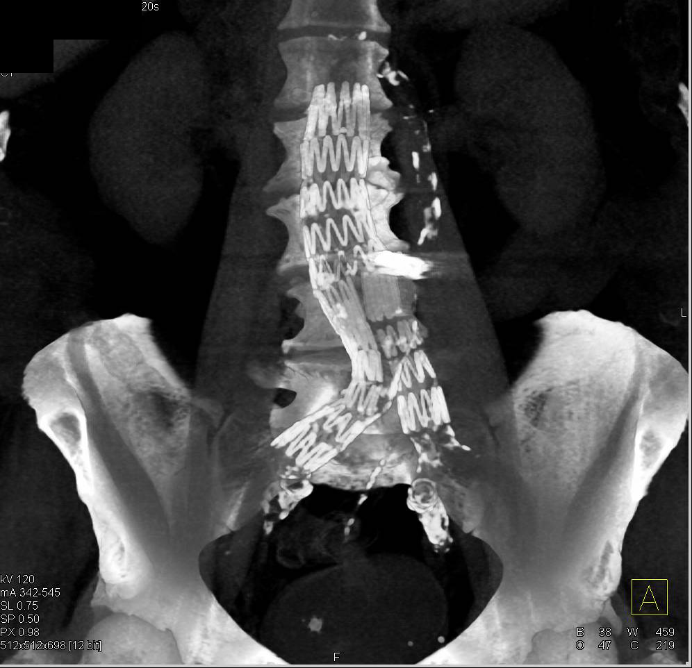 Endovascular Stent with Left Occluders - CTisus CT Scan