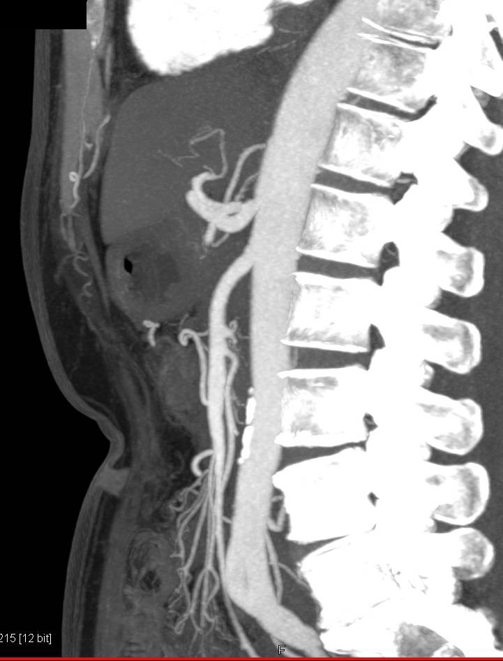 Normal Superior Mesenteric Artery (SMA) on MIP Images - CTisus CT Scan