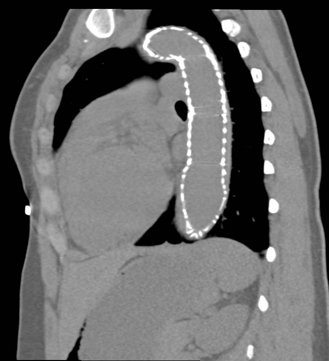 Endovascular Stent with Endoleak in Thoracic Aorta - CTisus CT Scan