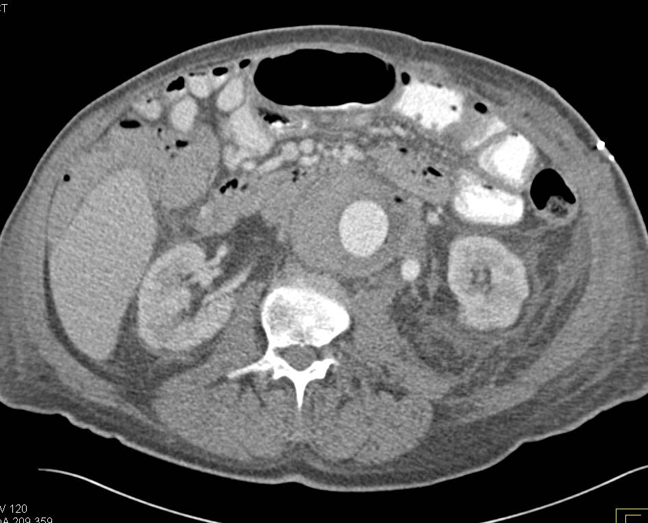 Aortic Aneurysm with Aorto-Enteric Fistulae. Note the Air in the Aortic Sac. - CTisus CT Scan