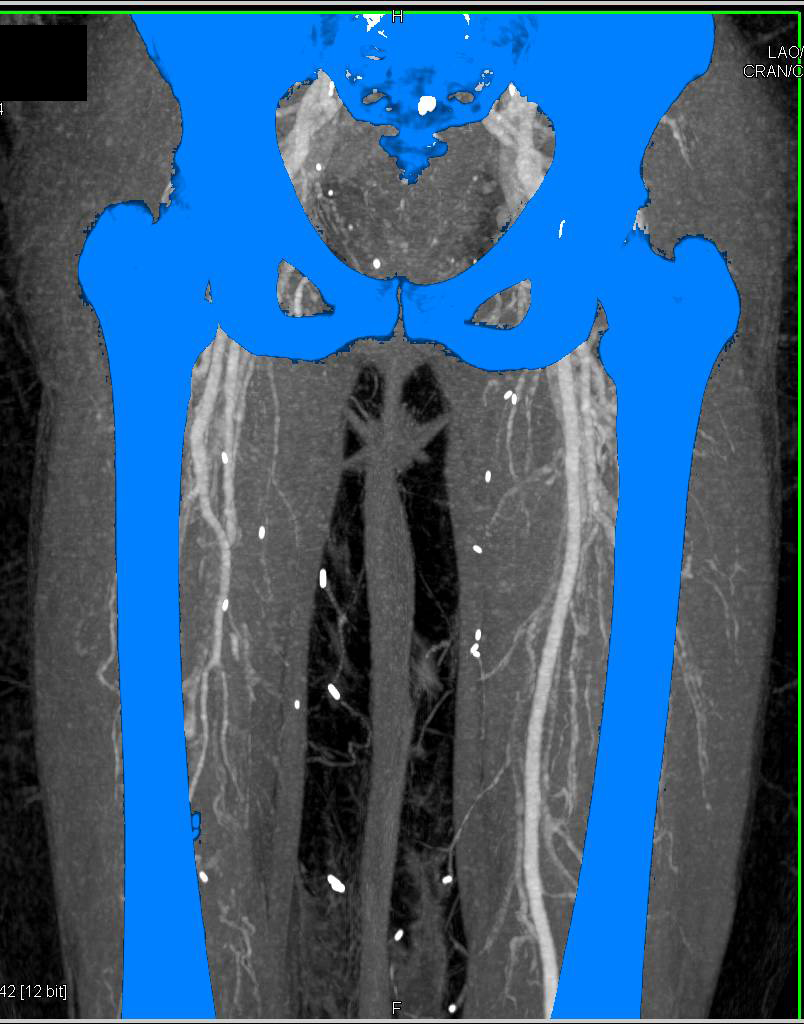 Right Superficial Femoral Artery (SFA) Narrowing and Occlusion with Collaterals - CTisus CT Scan