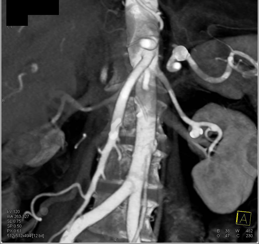 Incidental Renal Artery and Splenic Artery Aneurysm - CTisus CT Scan