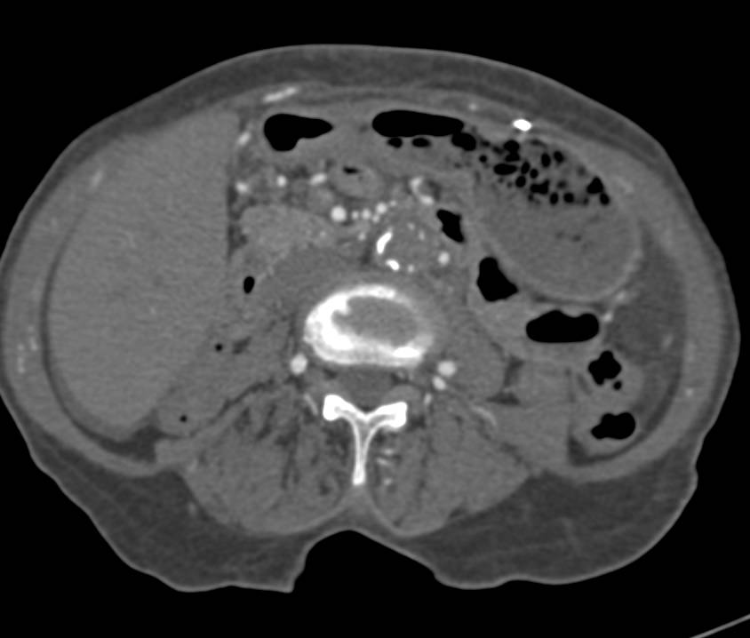 Abdominal Aortic Occlusion at L4 with External Iliacs Opacified by Collateral Flow - CTisus CT Scan