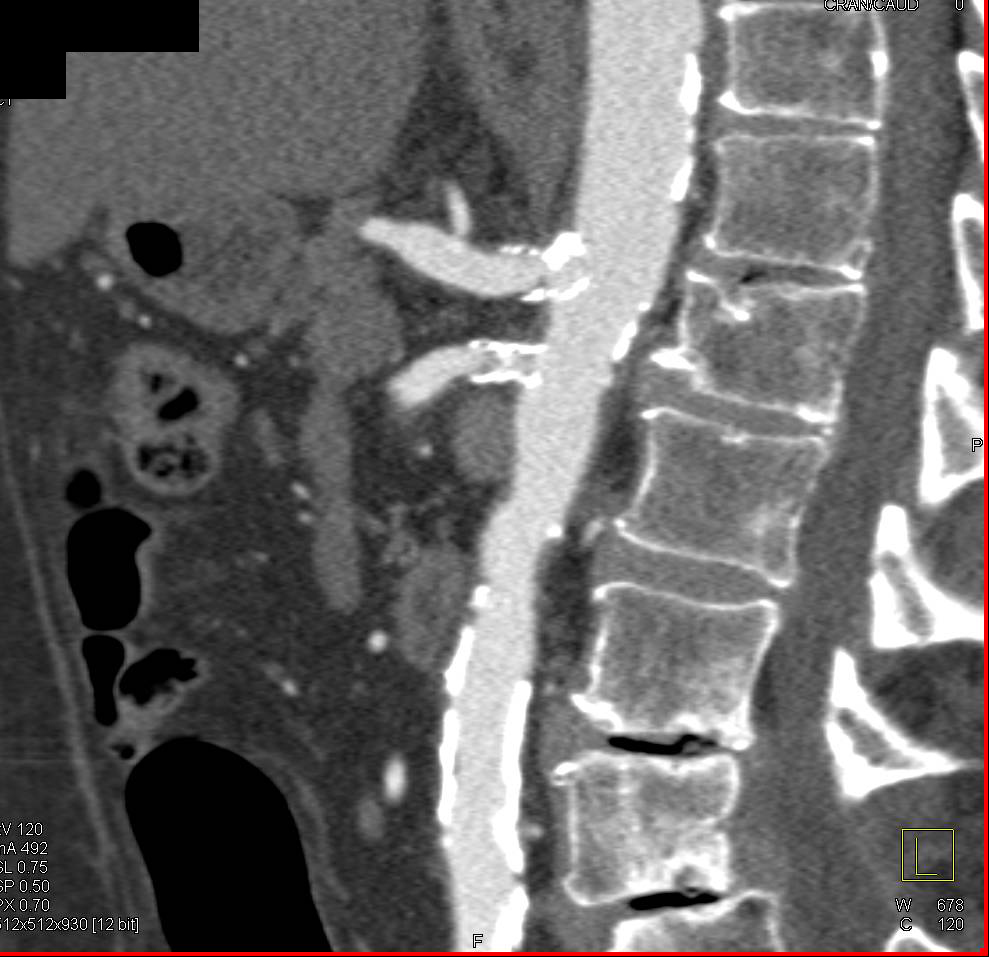 Stents in Origin of Celiac and SMA - CTisus CT Scan