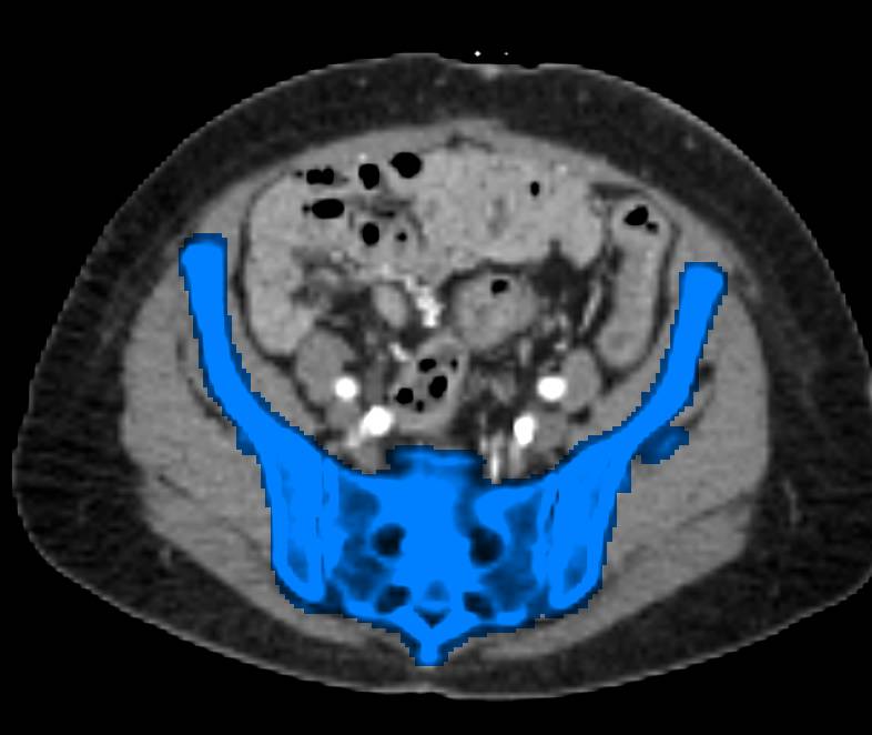 CTA Runoff with Left Superficial Femoral Artery (SFA) Occlusion Shown with Dual Energy and Single Energy Scans with Bone Editing - CTisus CT Scan