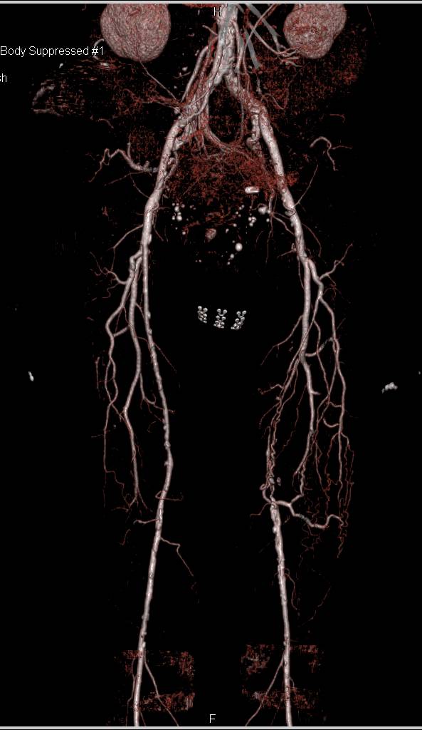 CTA Runoff with Peripheral Vascular Disease (PVD) Shown with Dual and Single Energy Scans - CTisus CT Scan