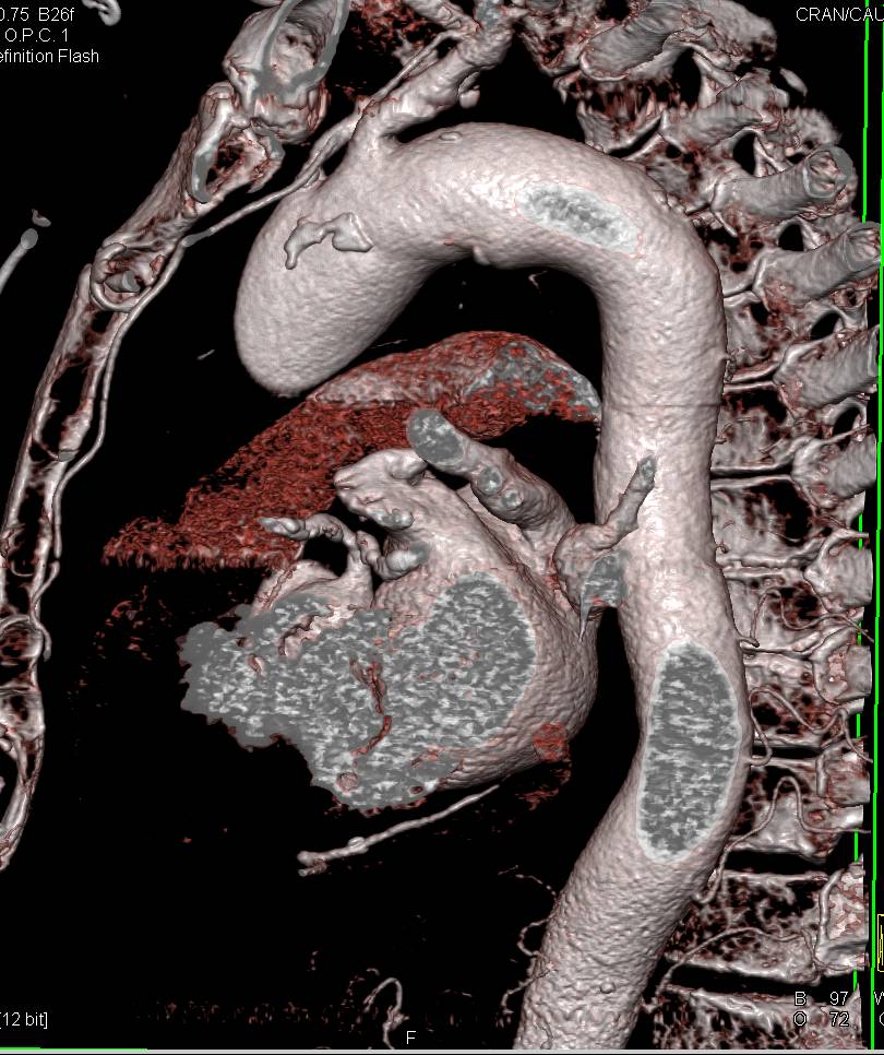 Dilated Ascending Aorta with Vascular Mapping - CTisus CT Scan