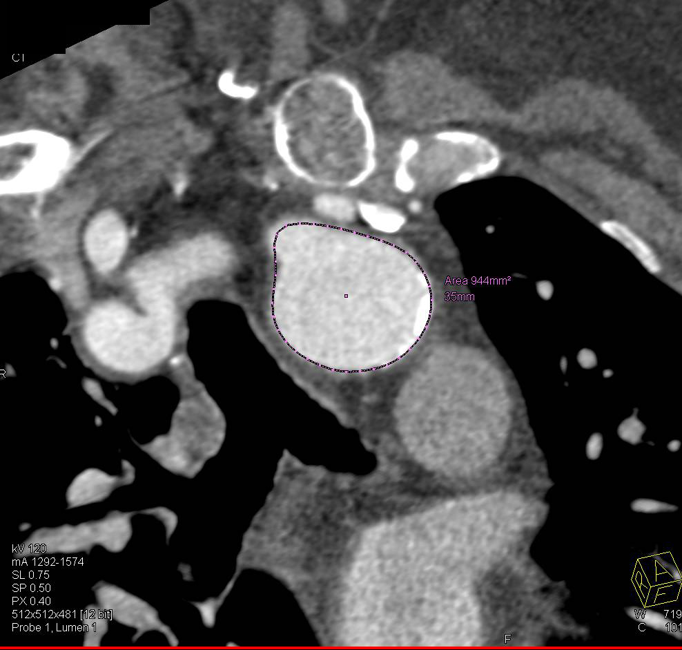 Dilated Aortic Arch - CTisus CT Scan