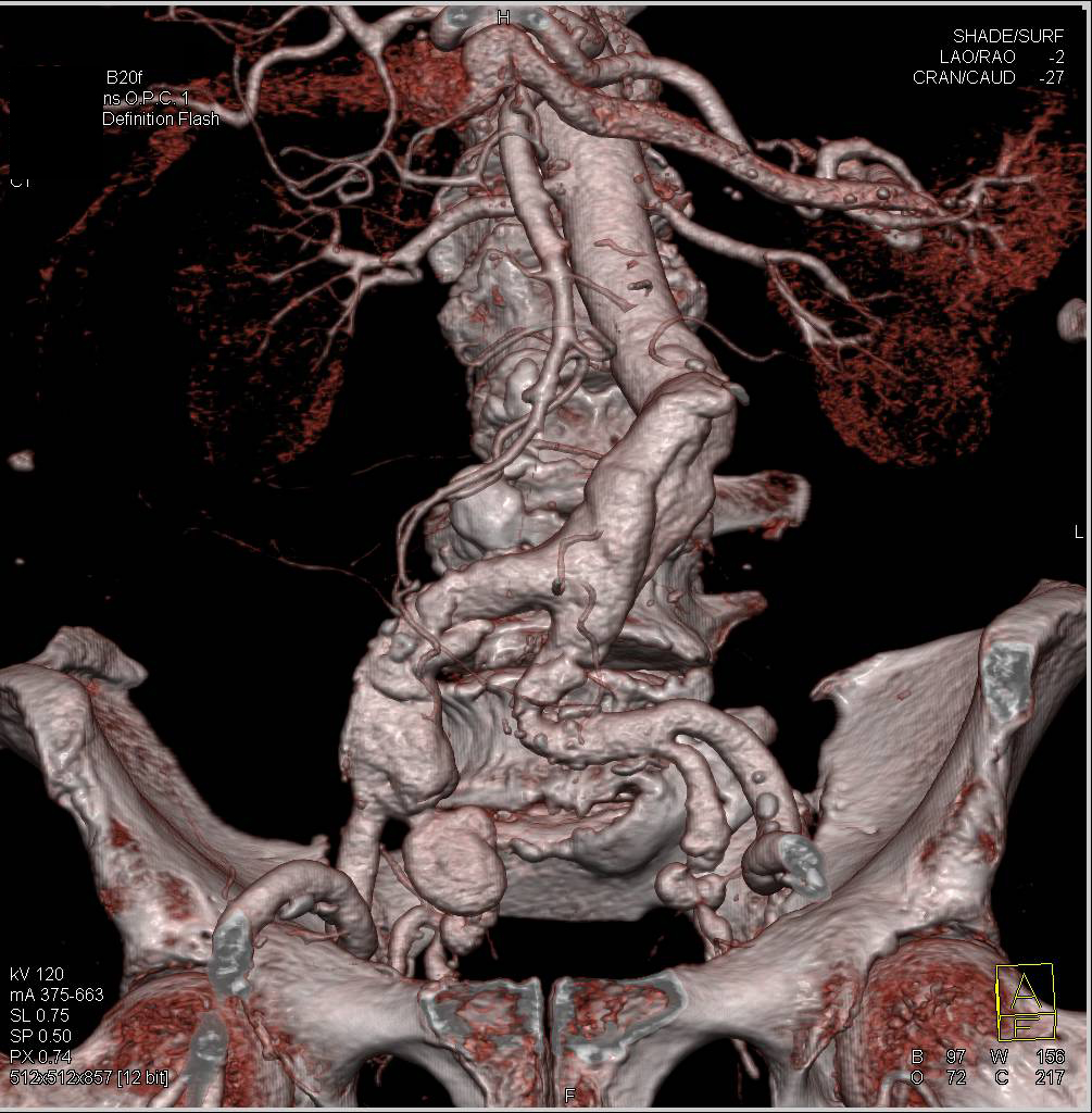 Dissection in Right Common Iliac Artery - CTisus CT Scan