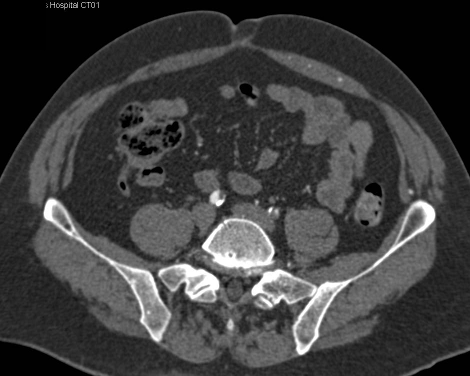 CTA Runoff with Peripheral Vascular Disease (PVD) with Bone Editing - CTisus CT Scan