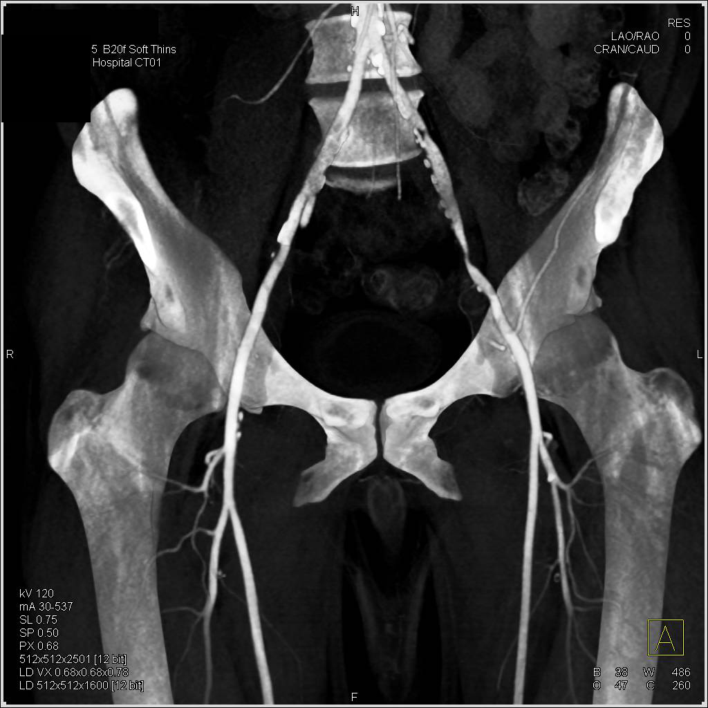 CTA Runoff with Peripheral Vascular Disease (PVD) with Bone Editing