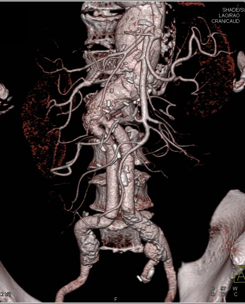 3D Map of an Aorto- Superficial Femoral Artery (SFA) Graft - CTisus CT Scan