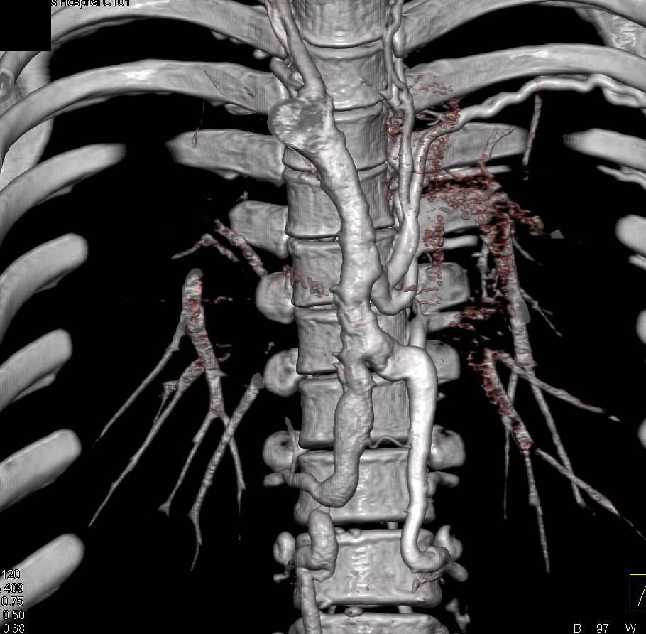 Superior Vena Cava (SVC) Occlusion with Stent and Patent Trachea - CTisus CT Scan